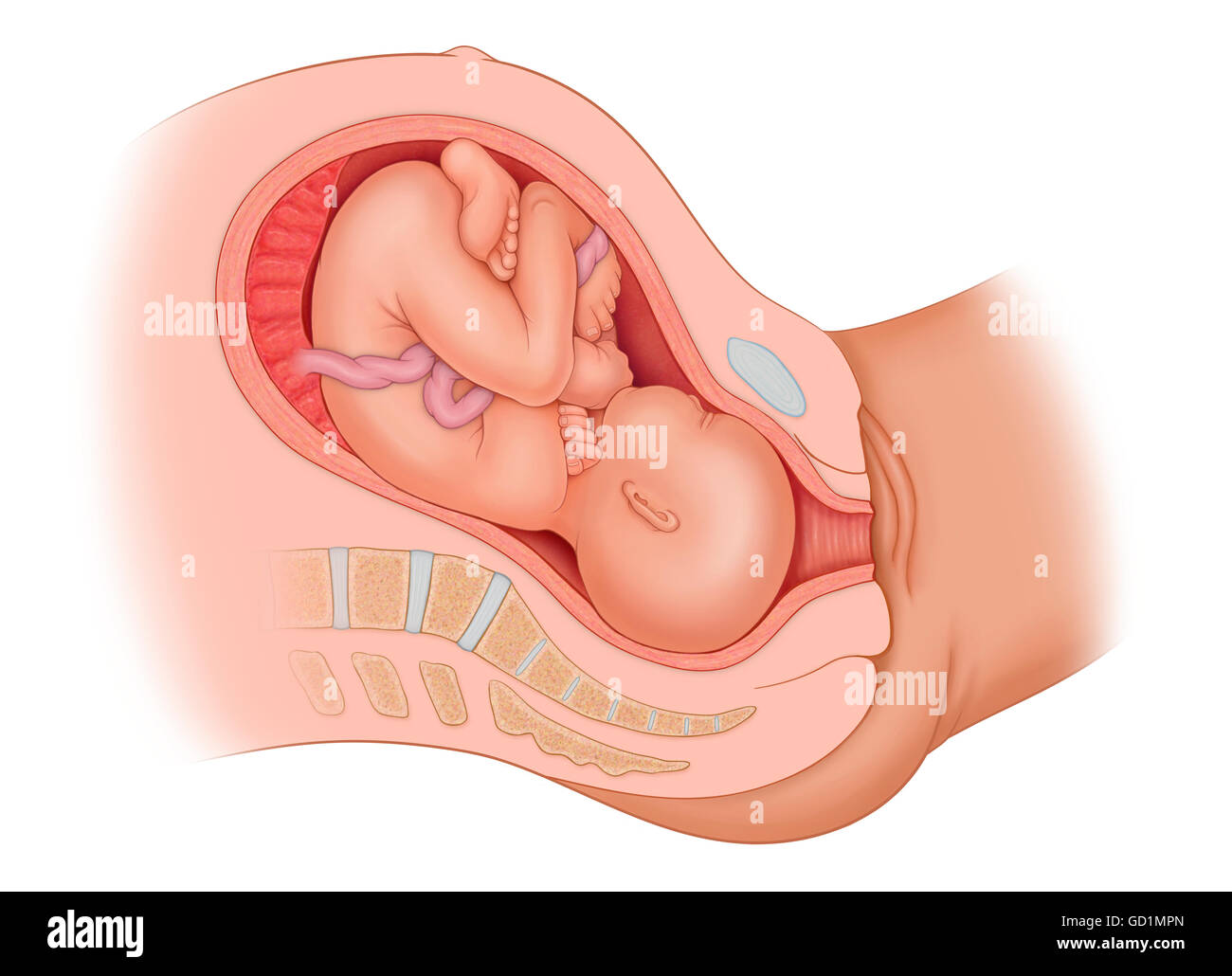 Sezione trasversale della madre's anatomy che mostra il bambino in uteruo ROP, in posizione errata Foto Stock