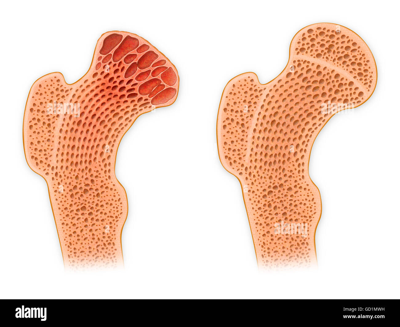 Sezione trasversale della testa del femore che mostra il normale midollo osseo versus artritiche del midollo osseo Foto Stock
