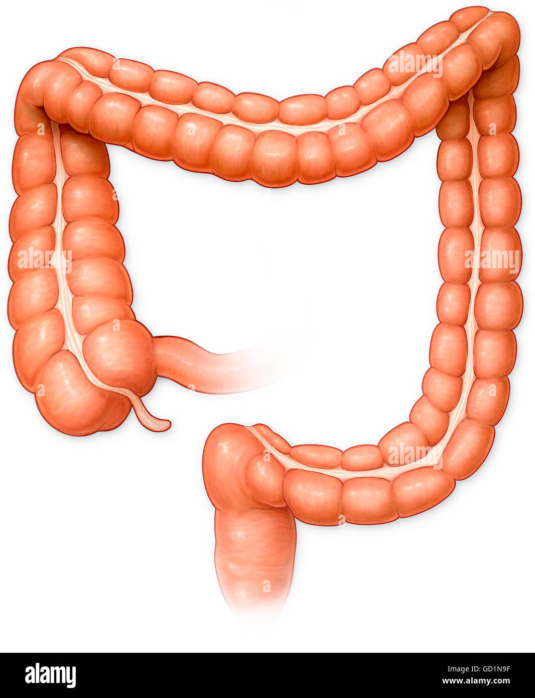 Vista anteriore del grosso intestino con diverticolite Foto Stock