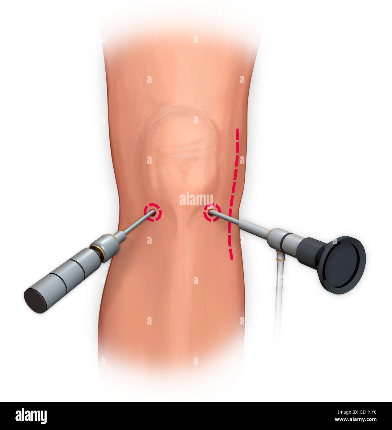Artroscopia la riparazione chirurgica del ginocchio Foto Stock