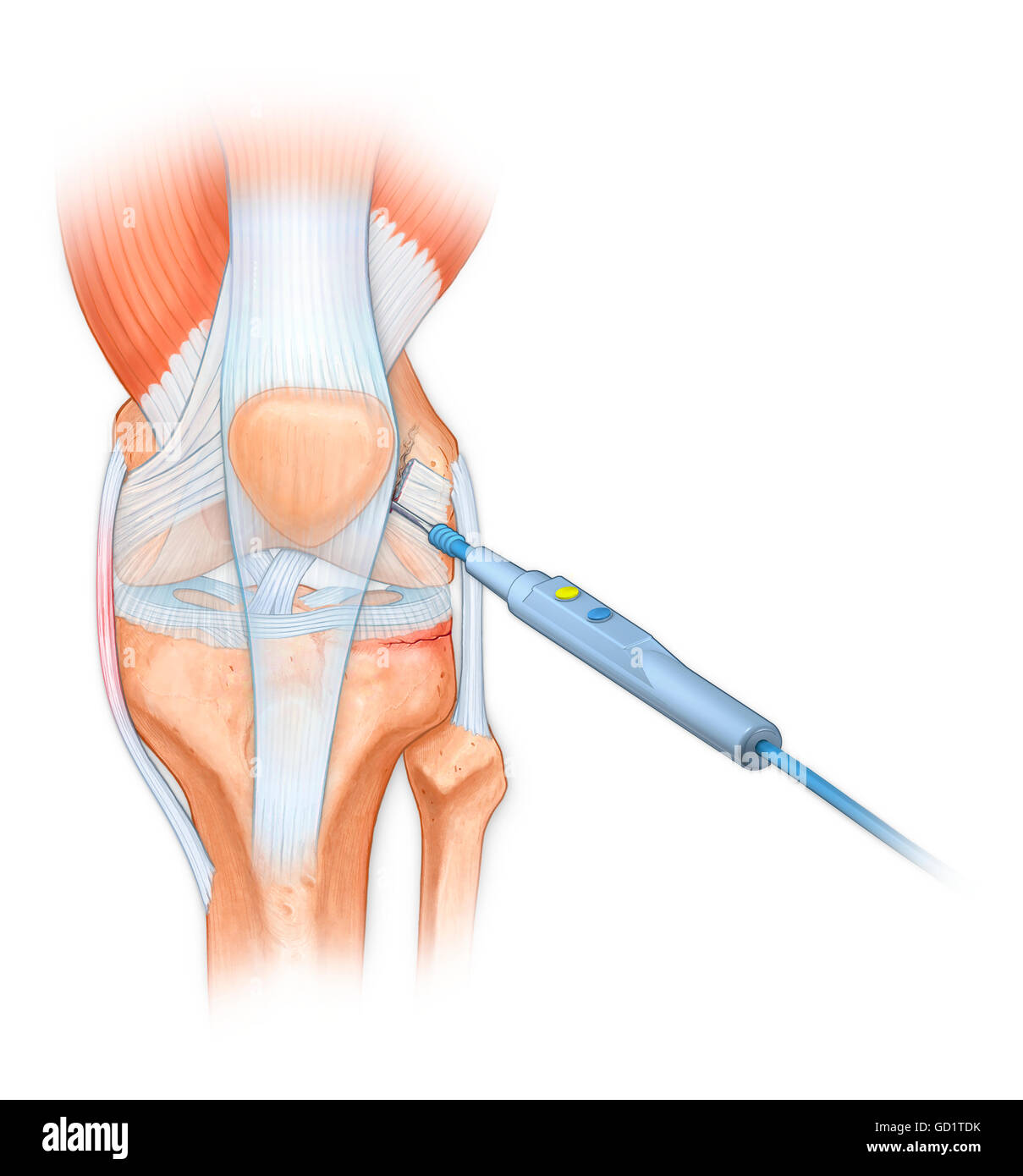 Bovie utilizzato per tagliare attraverso retincaculum, e ripulire il femore di sfollati rotuleo osso di ginocchio Foto Stock