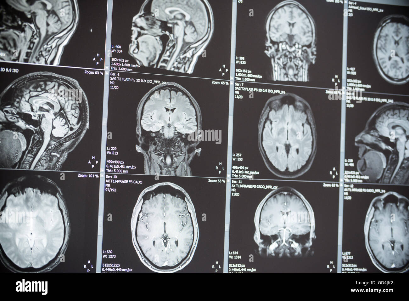 Immagini a risonanza magnetica (MRI) di un cervello Foto Stock