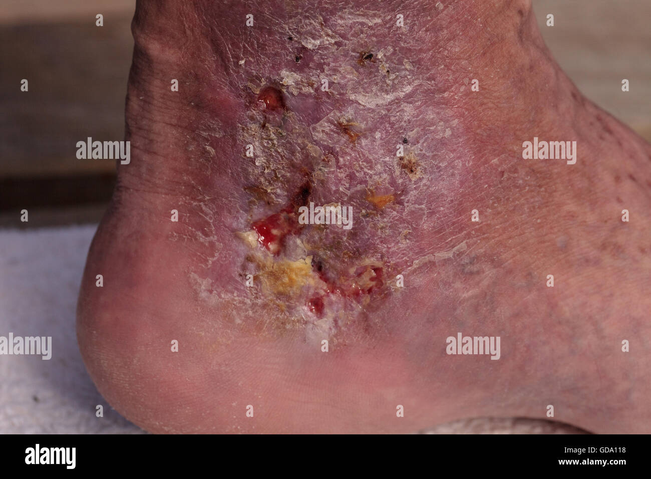 Immagini mediche: infezione cellulite sulla pelle di una caviglia causato da flebite e coaguli di sangue nella vena. Foto Stock