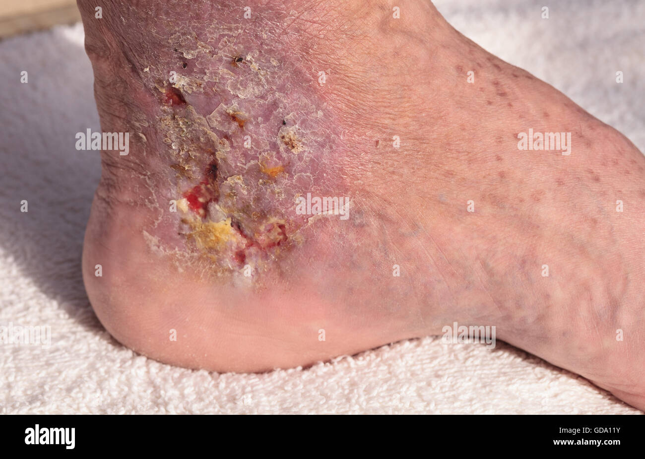 Immagini mediche: infezione cellulite sulla pelle di una caviglia causato da flebite e coaguli di sangue nella vena. Foto Stock