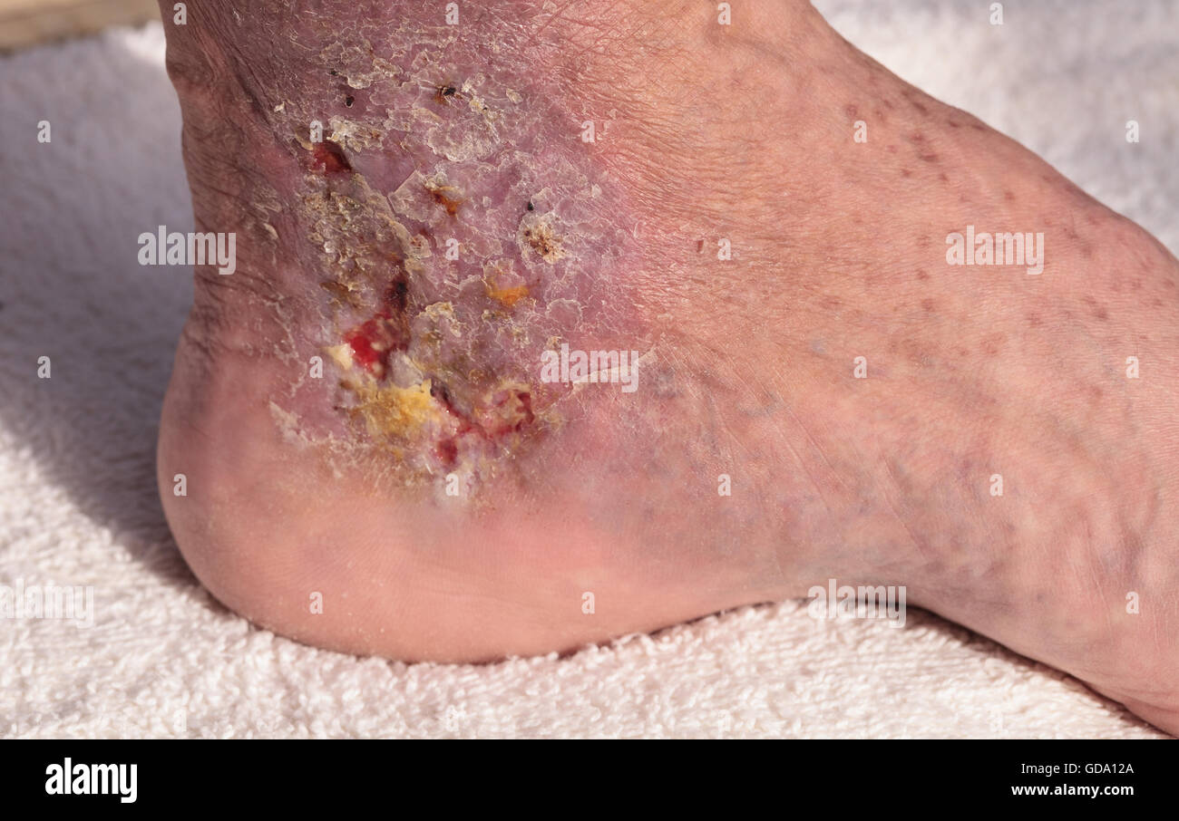 Immagini mediche: infezione cellulite sulla pelle di una caviglia causato da flebite e coaguli di sangue nella vena. Foto Stock