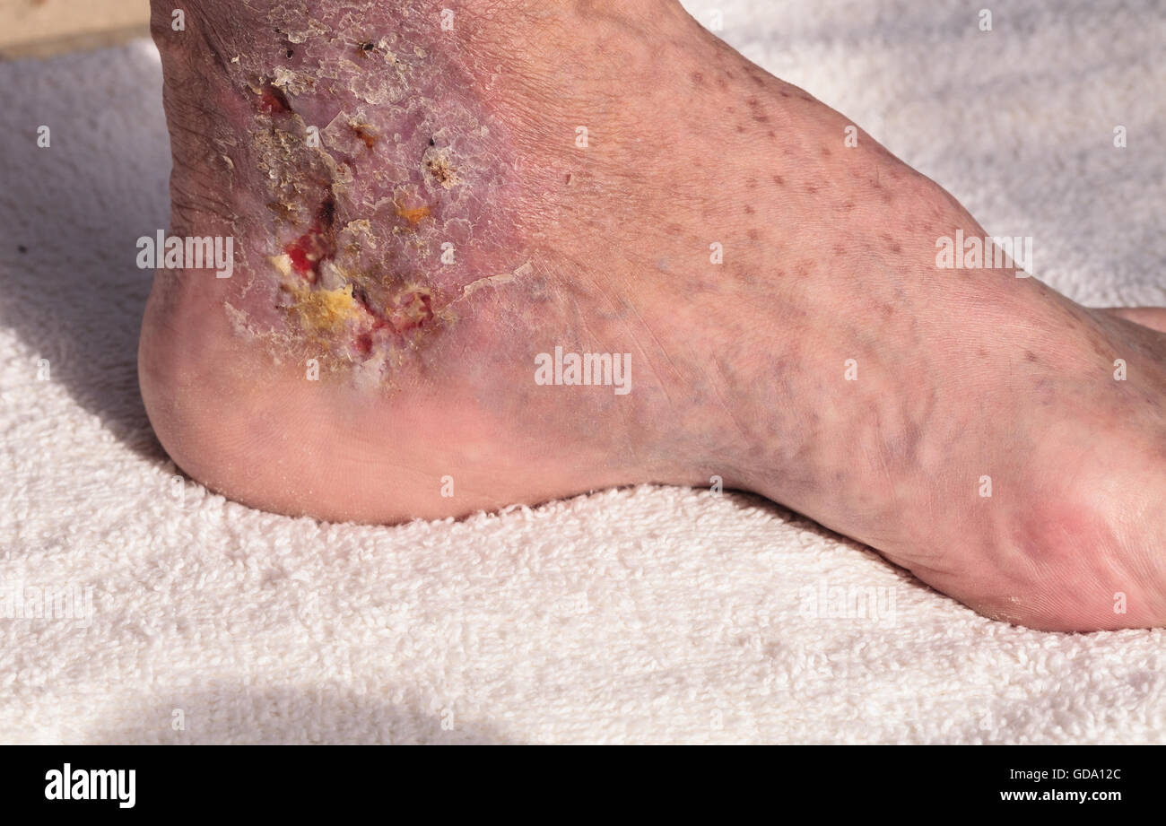 Immagini mediche: infezione cellulite sulla pelle di una caviglia causato da flebite e coaguli di sangue nella vena. Foto Stock