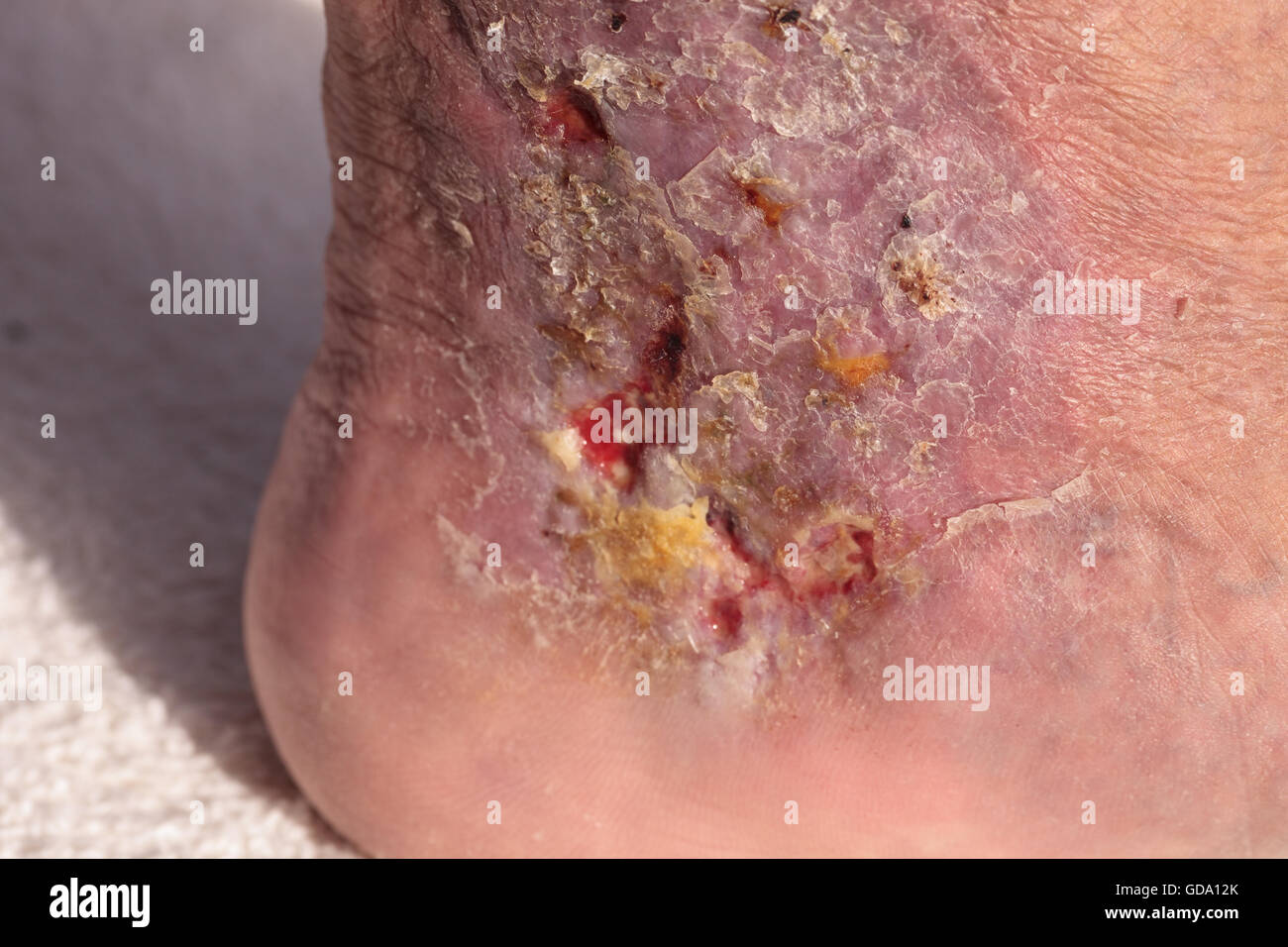 Immagini mediche: infezione cellulite sulla pelle di una caviglia causato da flebite e coaguli di sangue nella vena. Foto Stock