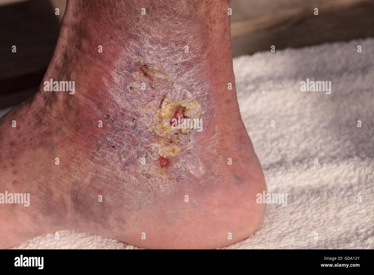 Immagini mediche: infezione cellulite sulla pelle di una caviglia causato da flebite e coaguli di sangue nella vena. Foto Stock