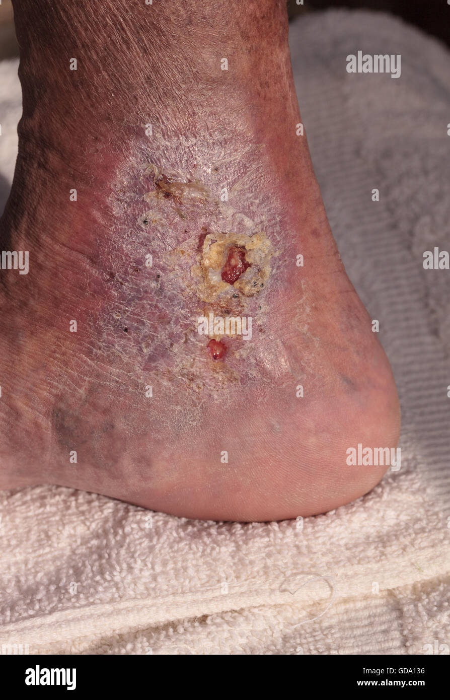 Immagini mediche: infezione cellulite sulla pelle di una caviglia causato da flebite e coaguli di sangue nella vena. Foto Stock