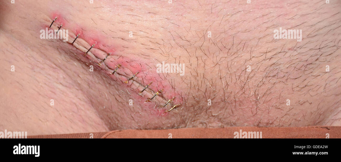 Close-up di 1 settimane vecchio castrazione cicatrice con 11 punti metallici Foto Stock