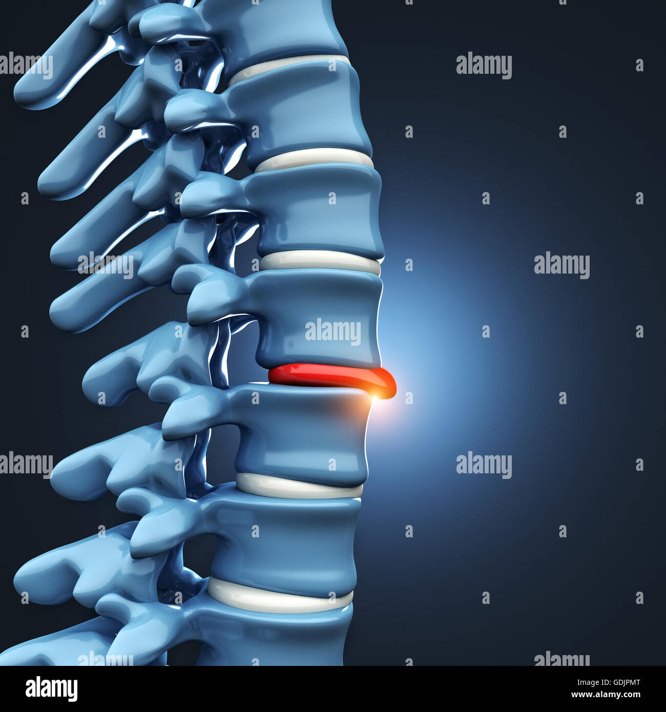 Immagine 3d di ernia del disco vertebrale umana Foto Stock