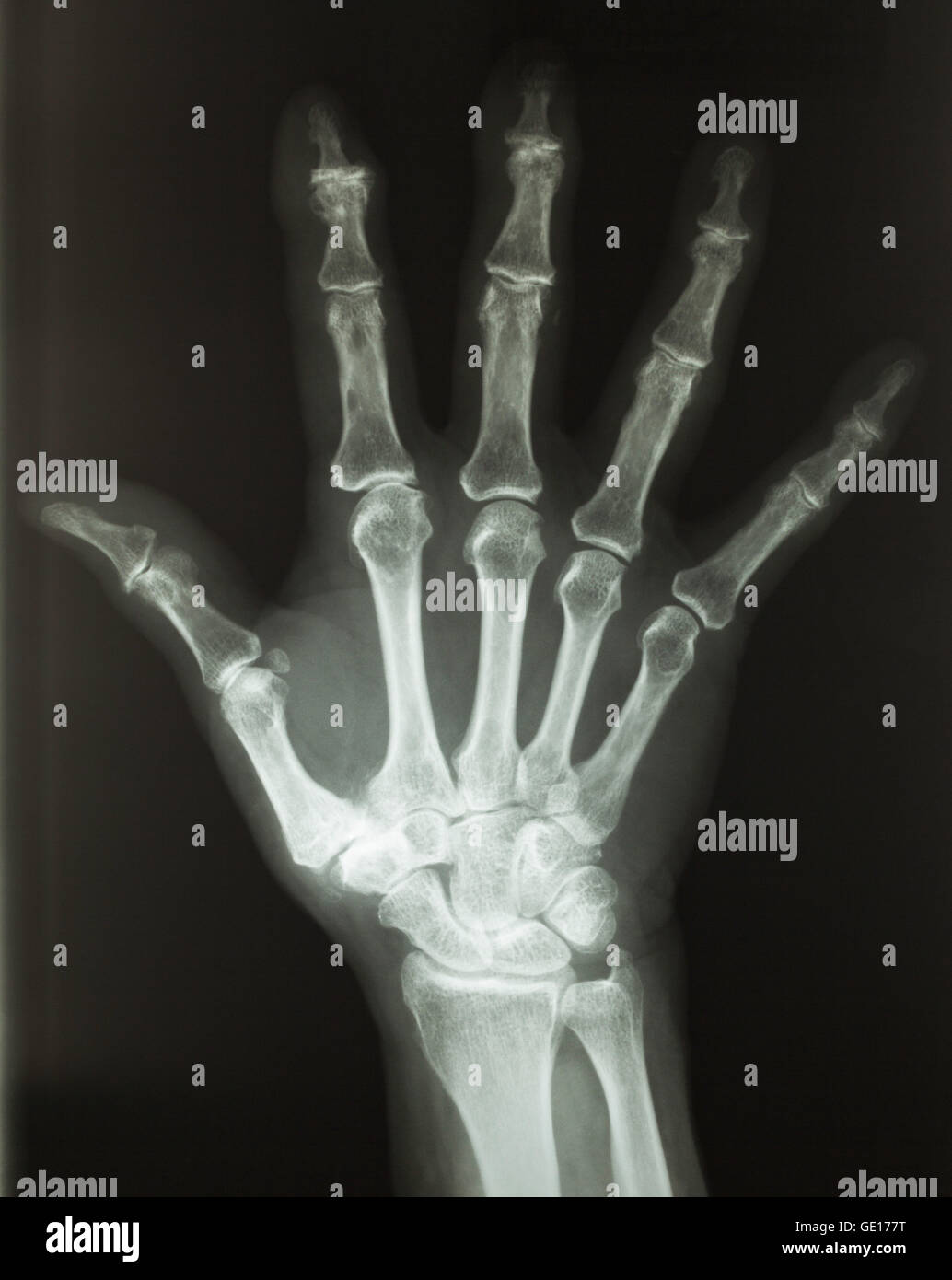 X-Ray della mano umana dalla vista dall'alto con le dita si diffondono. Foto Stock