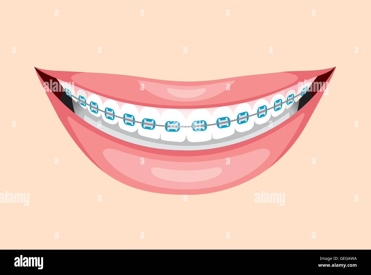 Bel sorriso con denti bretelle, medico, dentista, ospedale, Checkup, paziente, igiene, sani e di trattamento Illustrazione Vettoriale