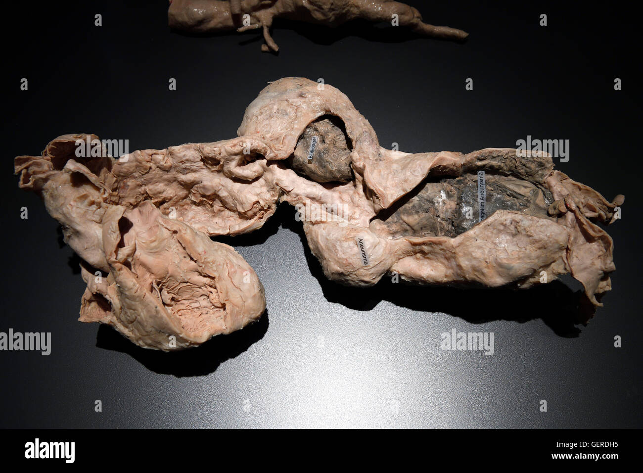 Plastinat, Anourysma einer aorta, il dottor Gunter von Hagens, MeMu, Menschen Museum di Berlino, Deutschland Foto Stock
