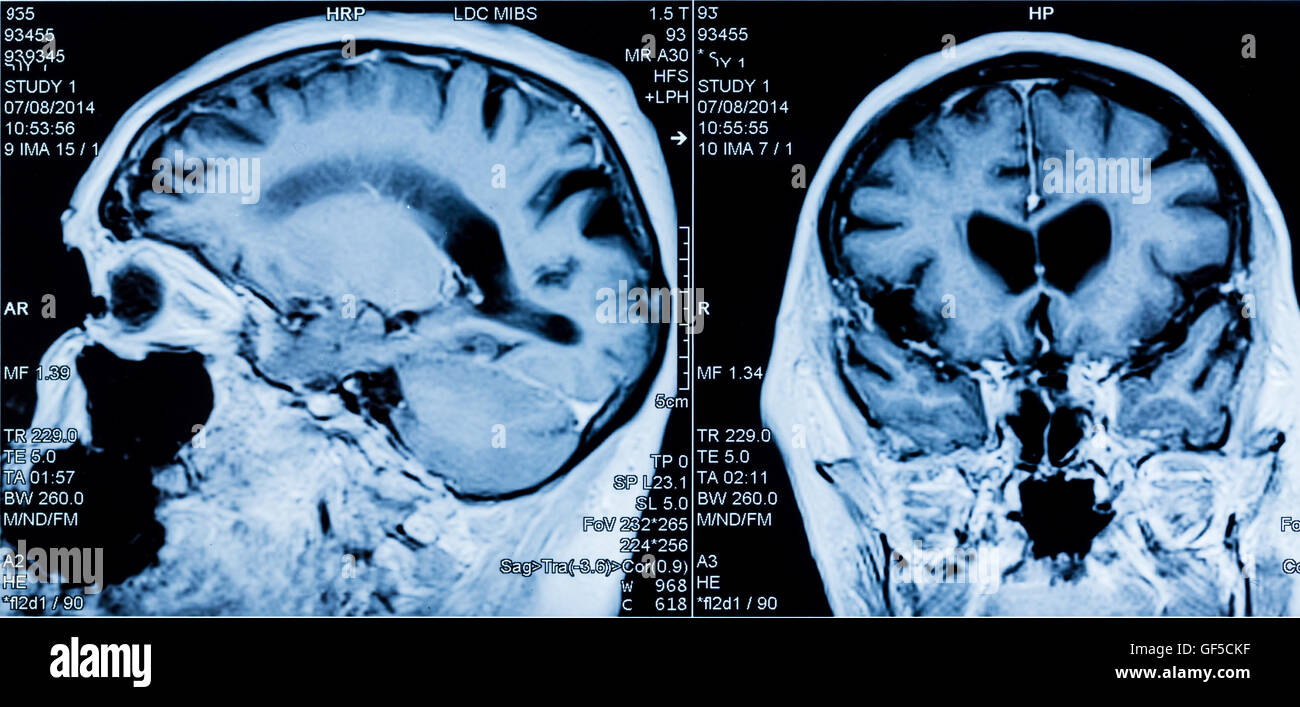 Testa MRI Scan Foto Stock