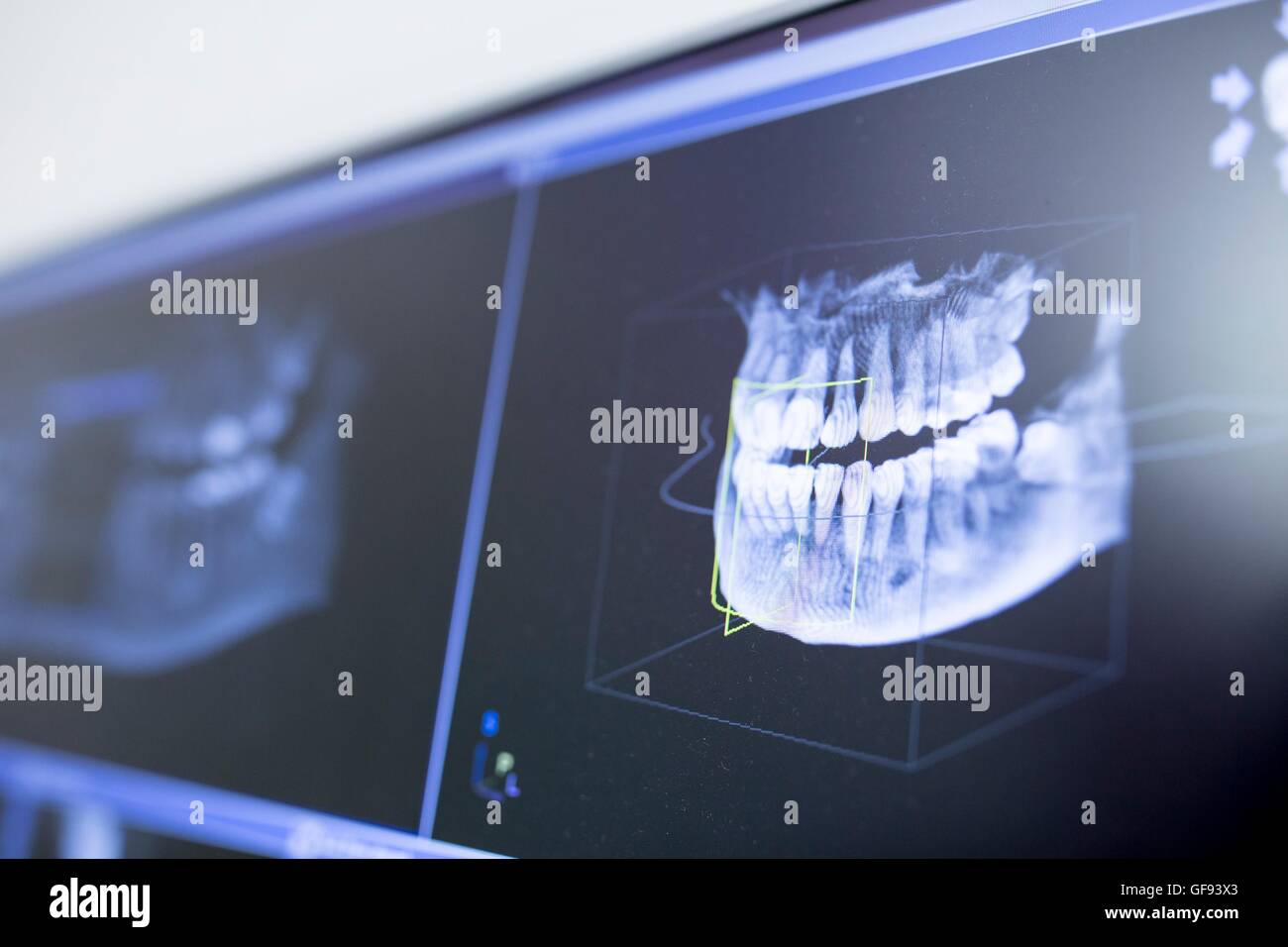 Close-up di denti x-ray in dentista clinica. Foto Stock