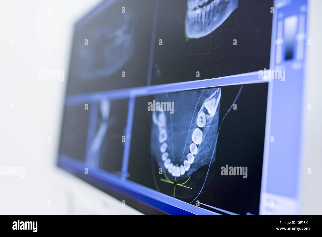 Close-up di denti x-ray display su schermo nella clinica del dentista. Foto Stock