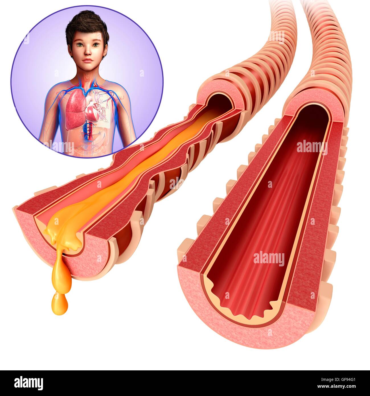 Illustrazione di adolescente di bronchi infetti. Foto Stock