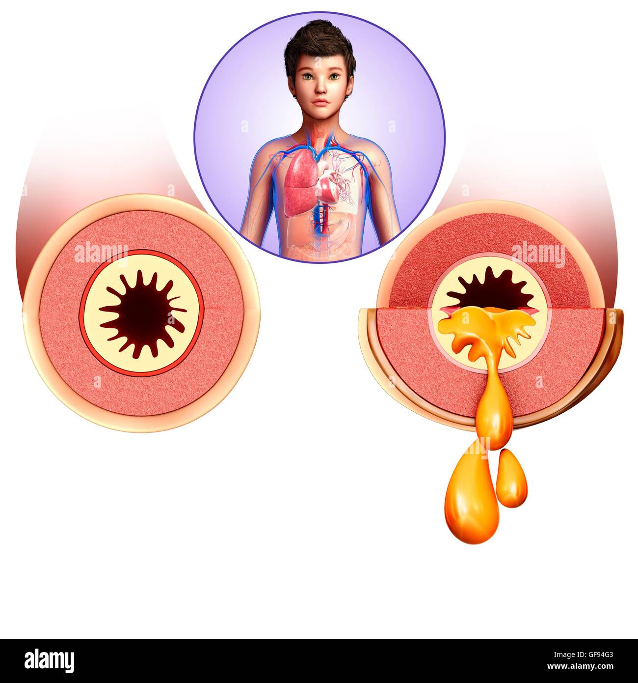 Illustrazione di adolescente di bronchi infetti. Foto Stock