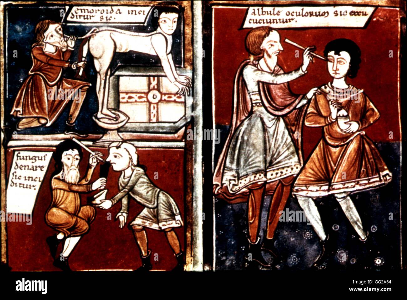 Manoscritto medico dalla scuola Salune Hemorroids, nasale polipo e cornea incisione 13-14 secolo medicina Londra, British museum Foto Stock
