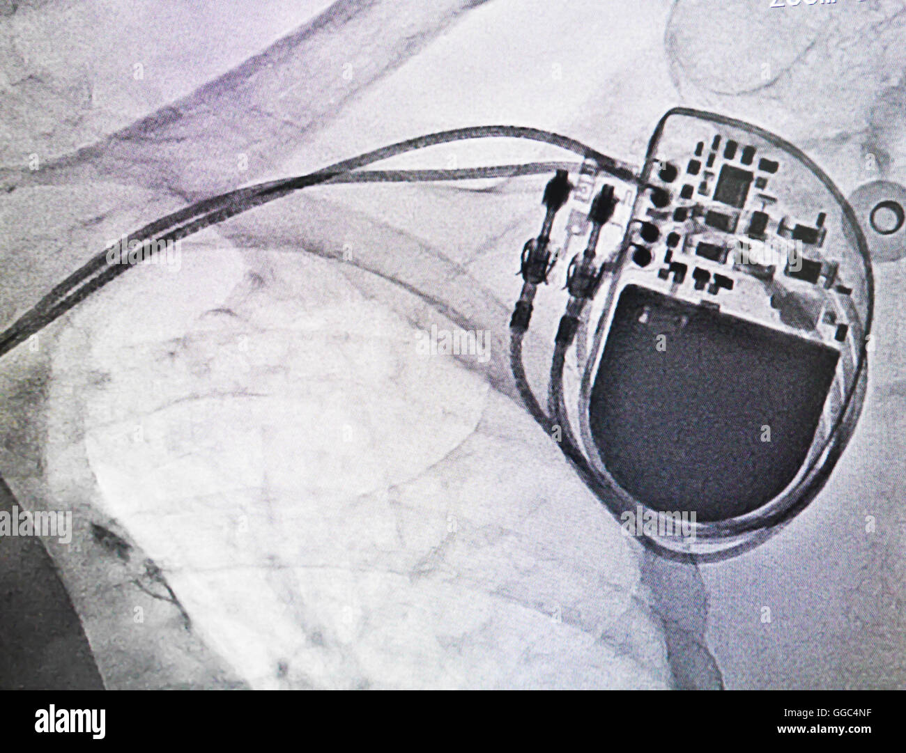 Pacemaker permanenti immagine a raggi x di cateterismo cardiaco Foto Stock