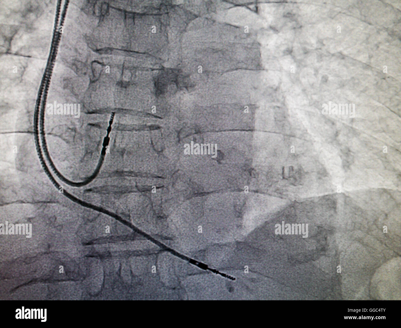 Pacemaker DDDR cavo in immagine a raggi x in un cateterismo cardiaco laboratorio Foto Stock