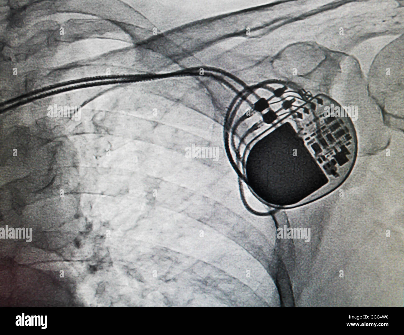 Pacemaker DDDR in immagine a raggi x in un cateterismo cardiaco laboratorio Foto Stock