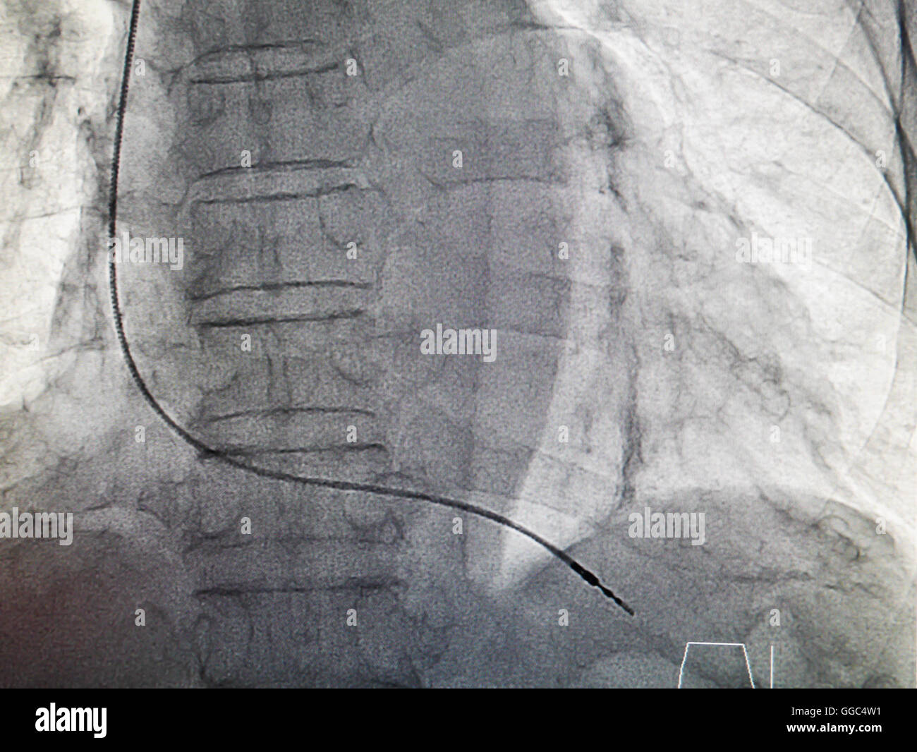 Pacemaker VVIR cavo in immagine a raggi x in un cateterismo cardiaco laboratorio Foto Stock