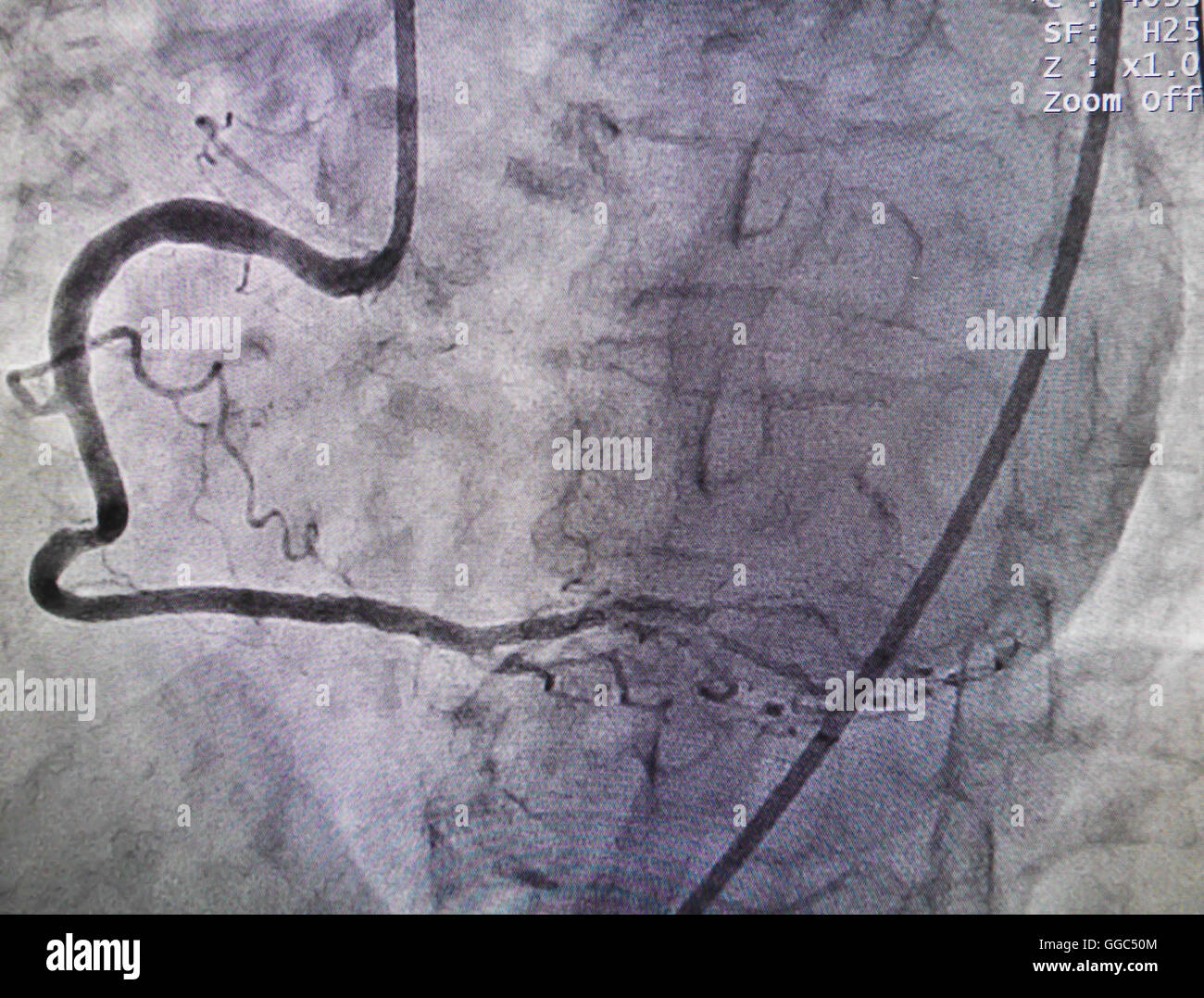 Arteria coronaria destra da raggi x in un cateterismo cardiaco laboratorio Foto Stock