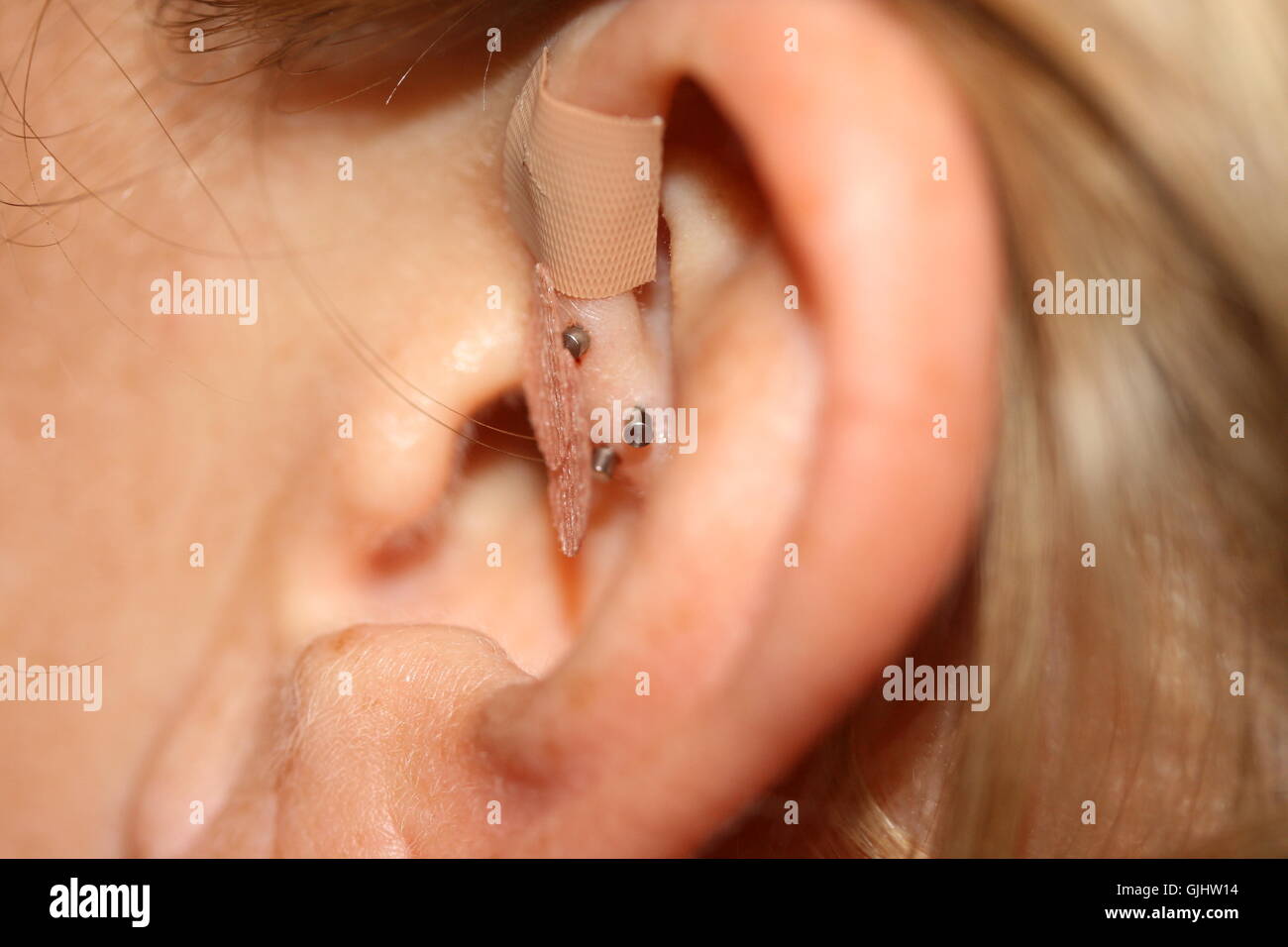 Orecchio con permanente aghi di agopuntura Foto Stock