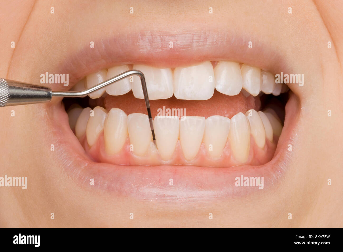 Germi dei denti immagini e fotografie stock ad alta risoluzione - Alamy