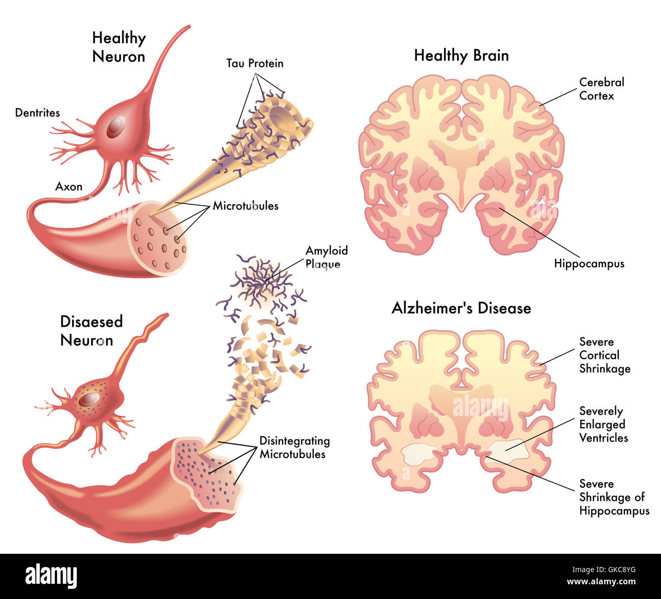 Cervello alzheimer confusione Foto Stock