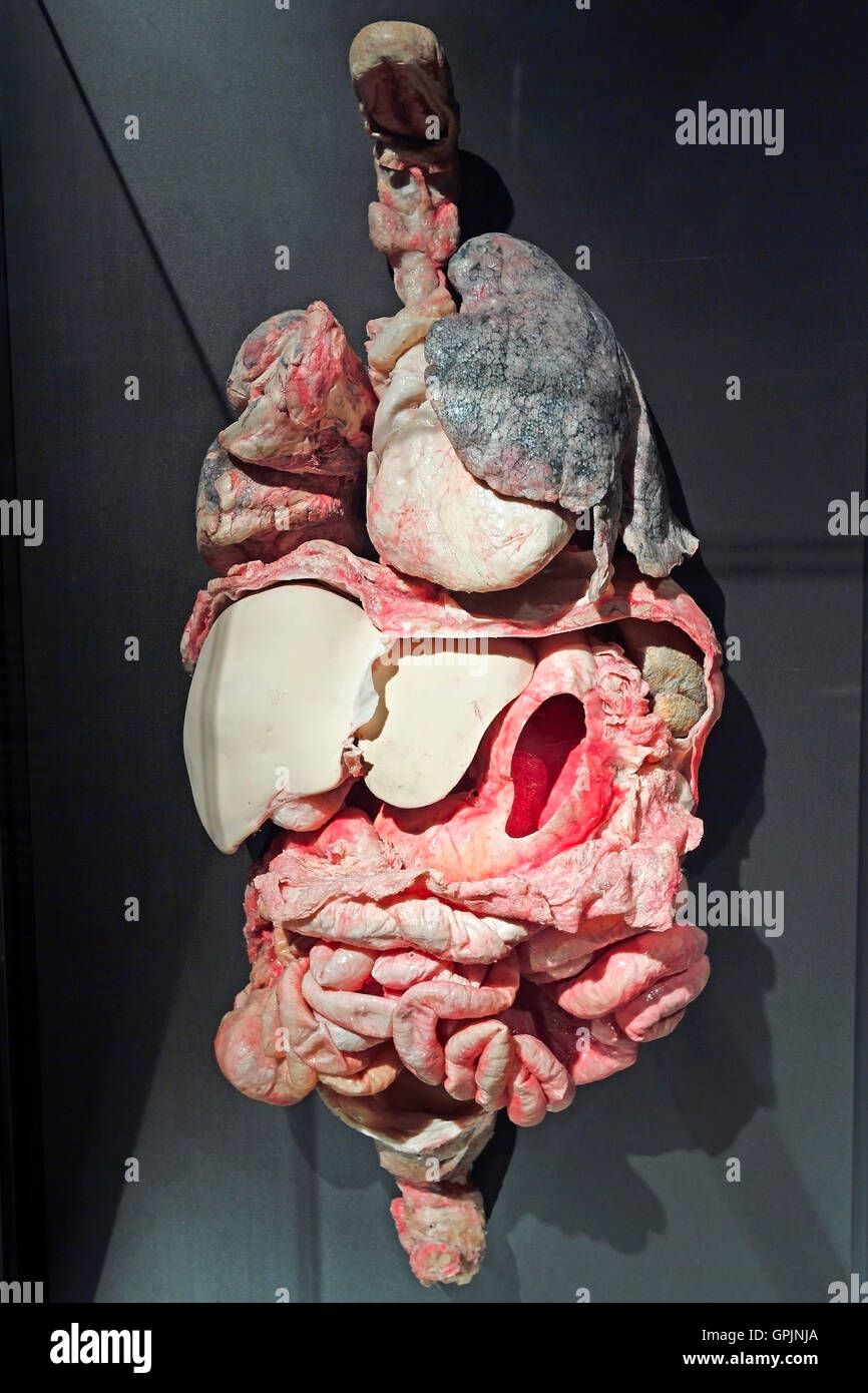 Plastinate, umano degli organi interni, malattia polmonare ostruttiva cronica, corpo mondi, Menschen Museum di Berlino, Germania Foto Stock