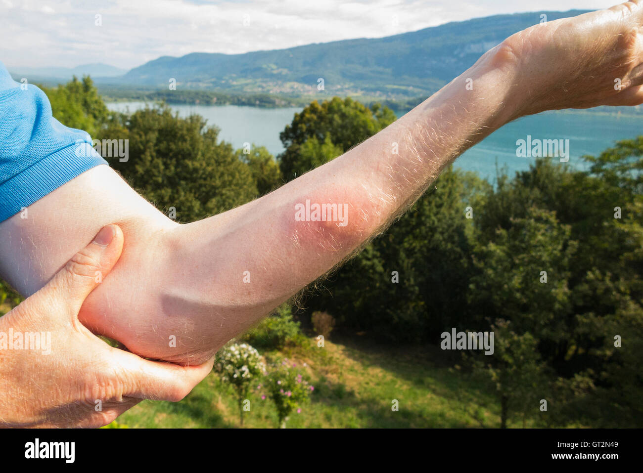Il braccio rialzato di un nuotatore turistico britannico con infiammazione causata dal furto di una "pulce d'anatra" ("puces de canard" in francese). LAC du Bourget, dove il nuotatore nuotava, è visibile in lontananza. Foto Stock