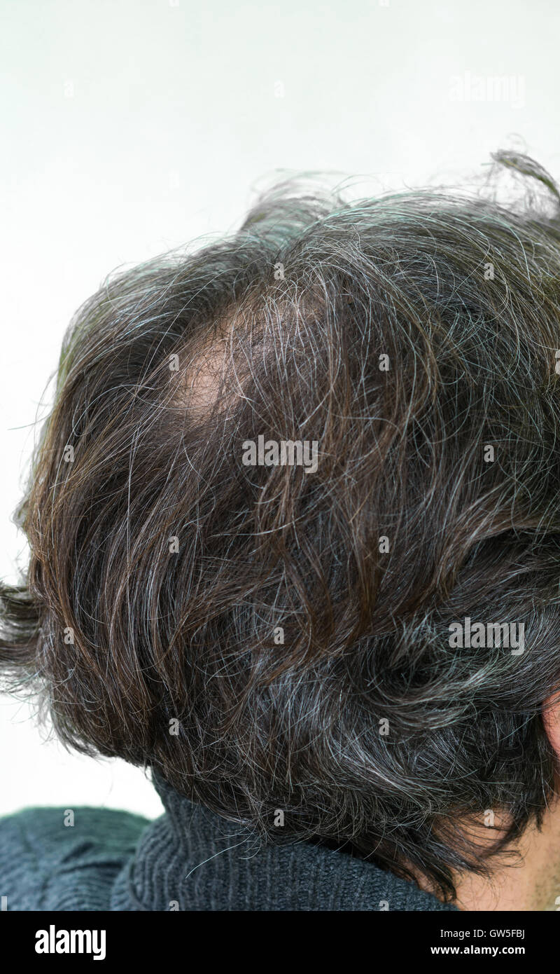 Maturo uomo yang, visto da dietro, nella testa, comincia a perdere i capelli, comincia ad essere vecchio. Foto Stock