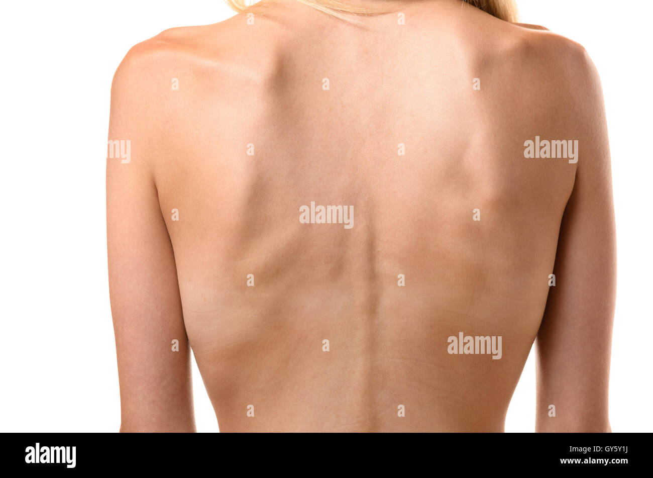 Vista posteriore della parte posteriore di una donna sottile che mostra le nervature e la spina dorsale in un concetto di assistenza sanitaria e i disturbi alimentari quali anoressia Foto Stock