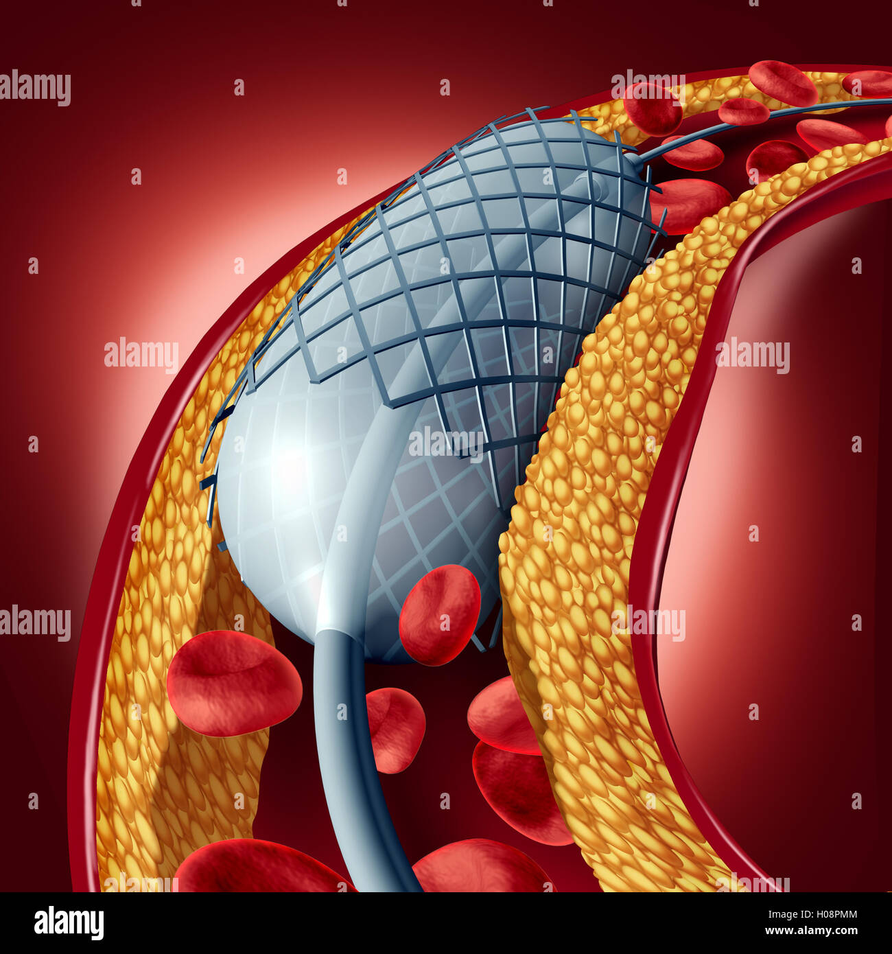Angioplastica e stent concetto come una malattia di cuore simbolo di trattamento con un impianto in una arteria che ha colesterolo ostruzione della placca essendo aperti per aumentare il flusso sanguigno come 3D'illustrazione. Foto Stock