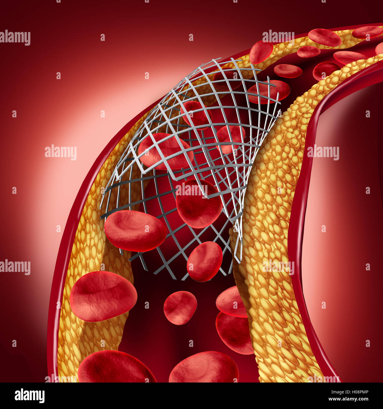 L'impianto dello stent concetto come una malattia di cuore simbolo di trattamento con una procedura di angioplastica in una arteria che ha colesterolo ostruzione della placca essendo aperti per aumentare il flusso sanguigno come 3D'illustrazione. Foto Stock