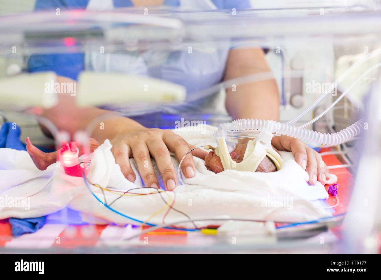 Prematuro neonato posto sotto assistenza respiratoria. Foto Stock