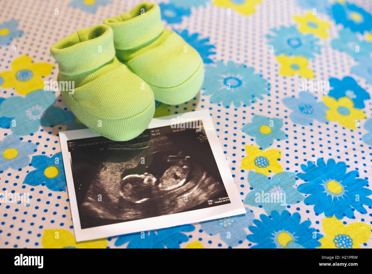 Ultrasuoni di una bambina e la piccola scarpe per bambini su un foglio in fiore Foto Stock