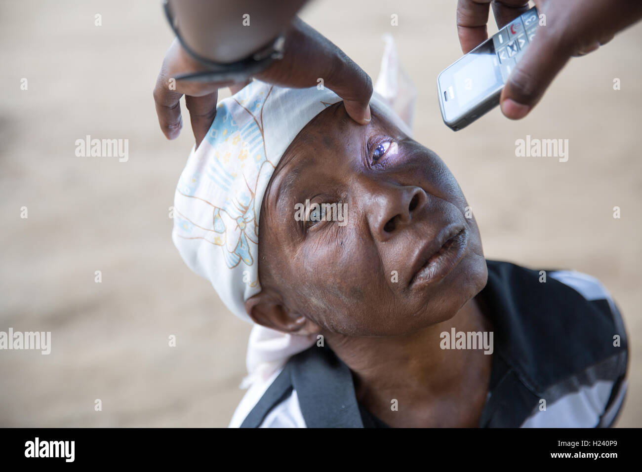 Città Lalaua, Nampula Provincia, Mozambico, Agosto 2015: una donna con cataratta bilaterale saranno prese per Ribaue ospedale a che esse vengano rimosse. Foto di Mike Goldwater Foto Stock