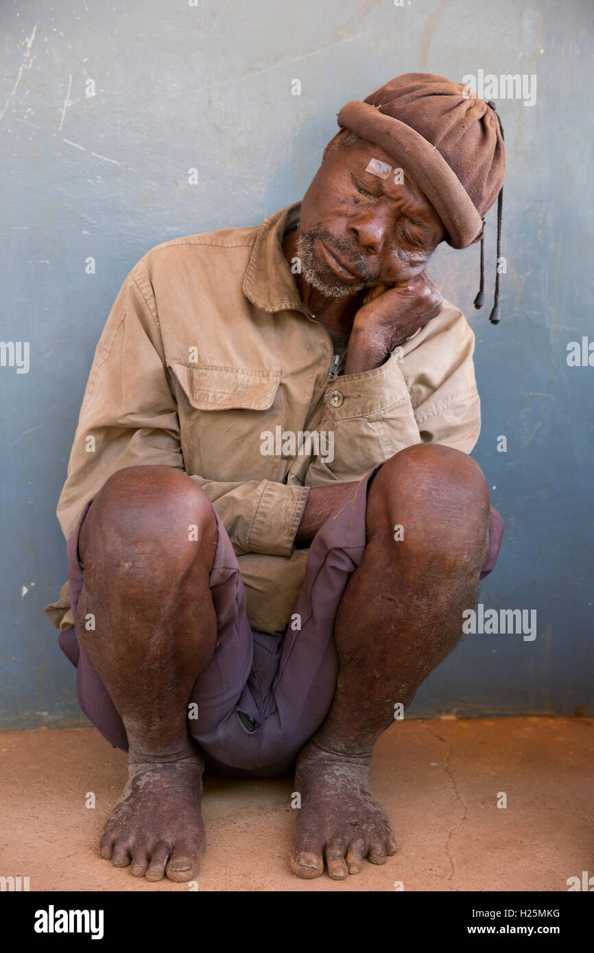 Ospedale Ribue, Nampula Provincia, Mozambico, Agosto 2015: Pacuneta Peteia, un fabbro da Mecuburi, attende la sua operazione di cataratta. Foto di Mike Goldwater Foto Stock