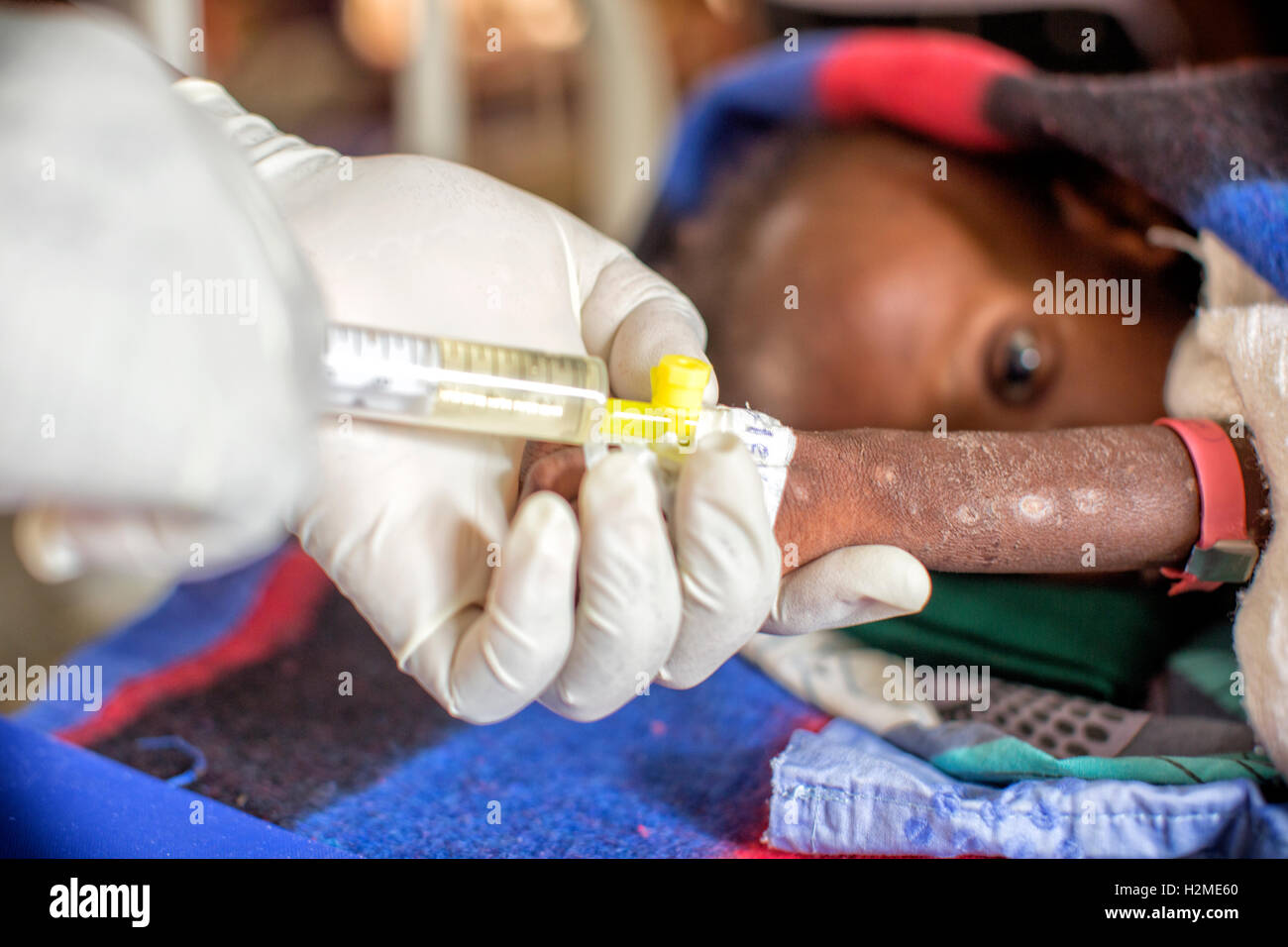 Un bambino malnutriti riceveranno un trattamento salvavita alla malnutrizione MSF ward a Maiduguri, Stato di Borno, Nigeria Foto Stock