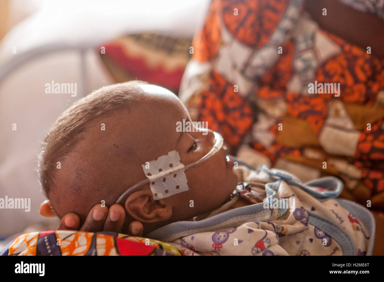 Un bambino malnutriti riceveranno un trattamento salvavita alla malnutrizione MSF ward a Maiduguri, Stato di Borno, Nigeria Foto Stock