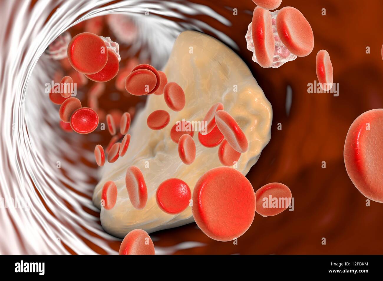 Placche ateromatose all'interno del vaso sanguigno, illustrazione del computer. Colesterolo ateroma causando un restringimento di una arteria (aterosclerosi). Foto Stock