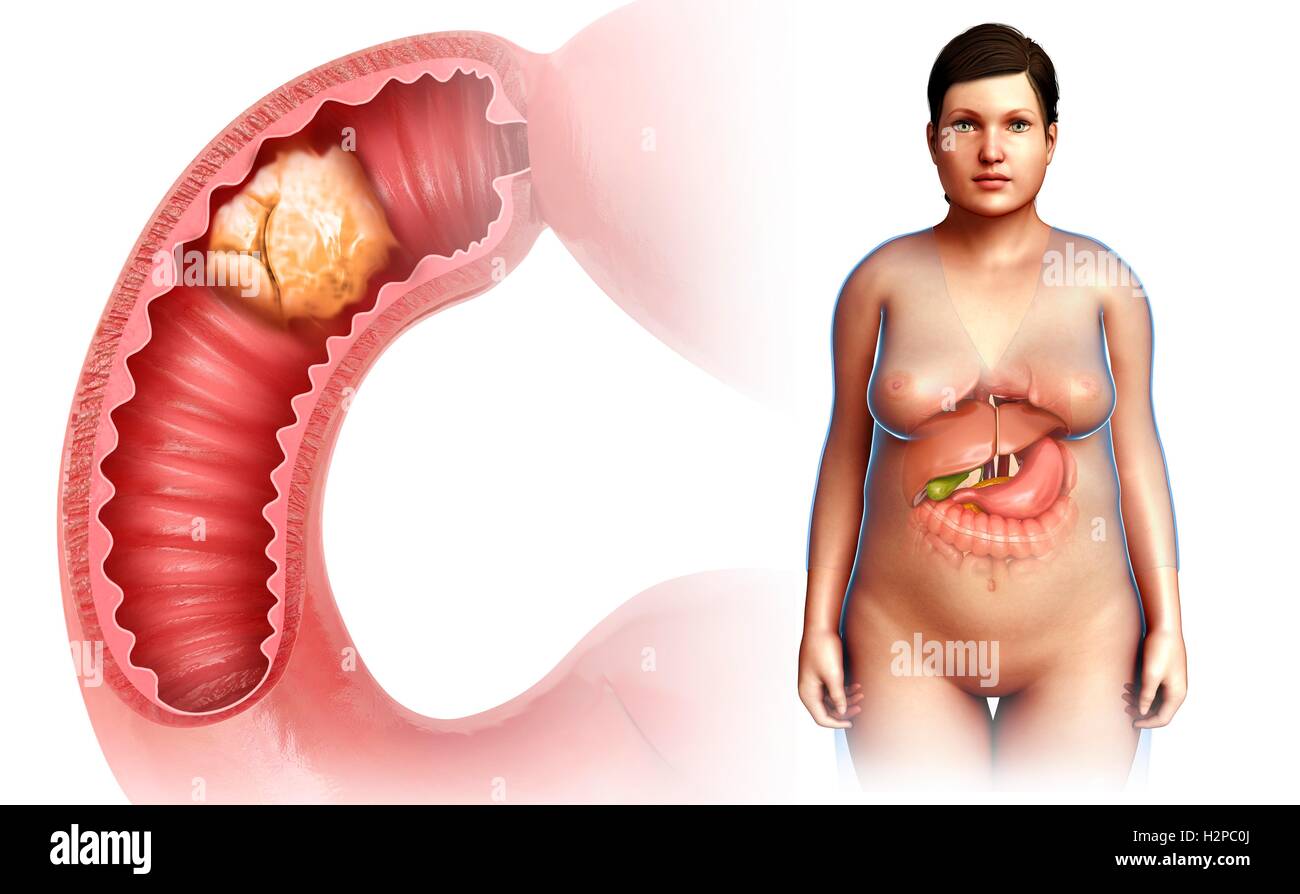 Illustrazione di una donna con il piccolo intestino cancro. Foto Stock