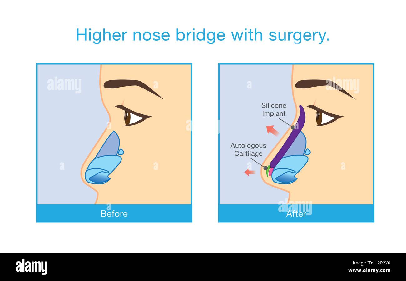 Maggiore ponte per il naso con la chirurgia. Illustrazione Vettoriale