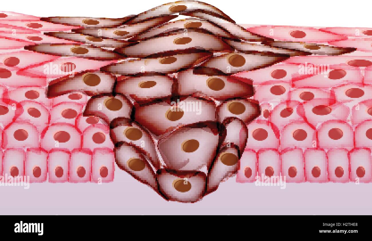 Tumore, sezione di tessuto - Illustrazione Vettoriale Illustrazione Vettoriale