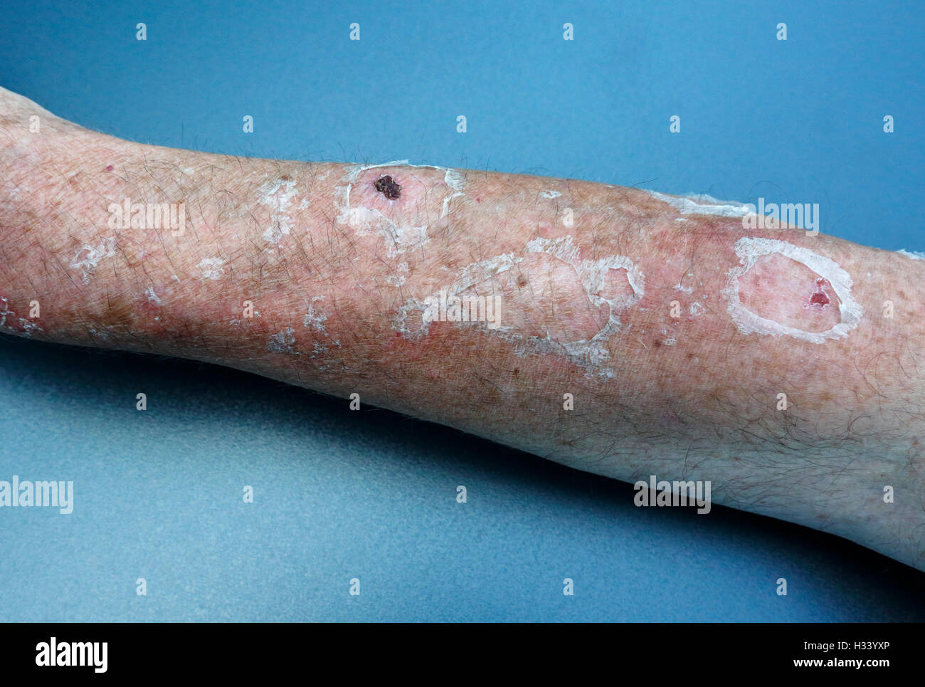 Salute, medicinali, avambraccio danni cutanei, formazione di vesciche e peeling pelle provocate da scottature Foto Stock