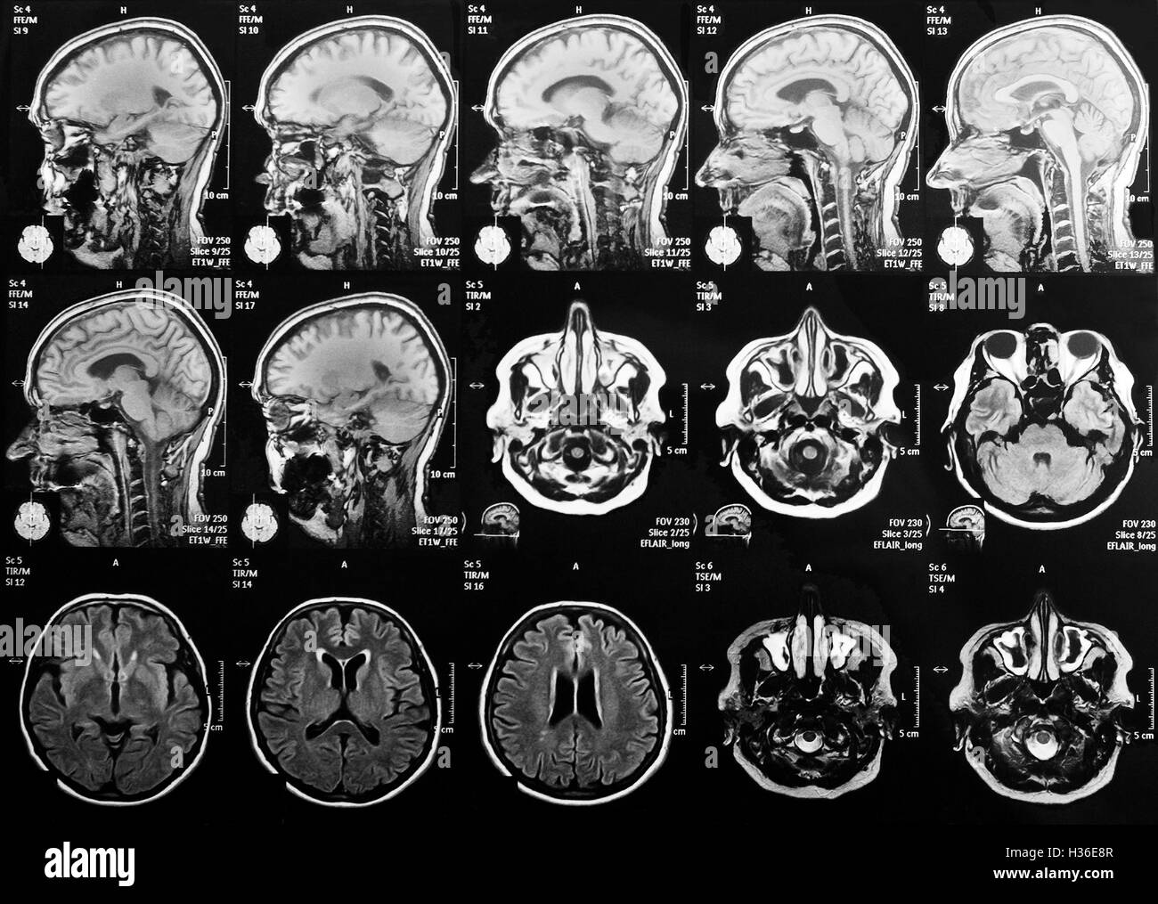 Il rilevamento di immagini in risonanza magnetica nucleare del cervello Foto Stock